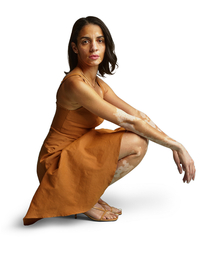 Woman with vitiligo kneeling
