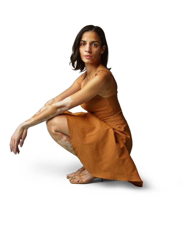 Woman with vitiligo kneeling