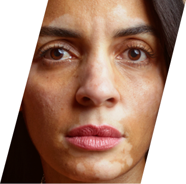 Close up of a woman with vitiligo on her face