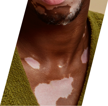 Close up vitiligo on black skin