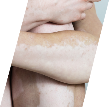 Close up vitiligo on white skin