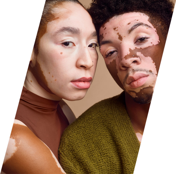 Two people showing vitiligo on their faces