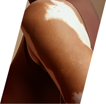 Close up vitiligo skin