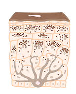 Illustration depicting where an immune system destroys melanocytes and depigments the skin