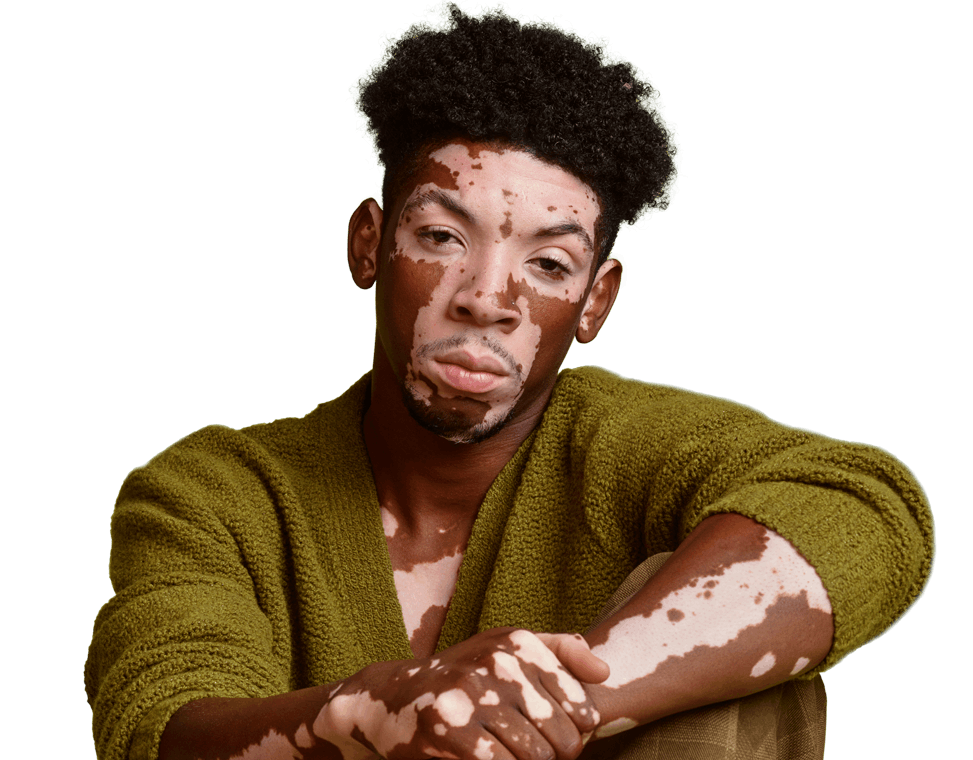 Man with vitiligo