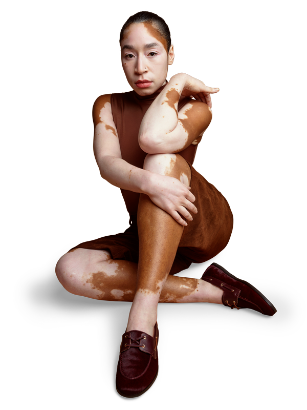 Woman with vitiligo