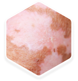 Close-up view of skin demonstrating Koebner's phenomenon, with irregular patches of depigmentation.