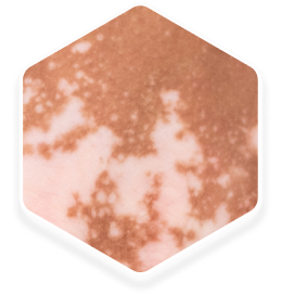 Skin texture demonstrating confetti-like depigmentation, with small, scattered patches of lighter color.