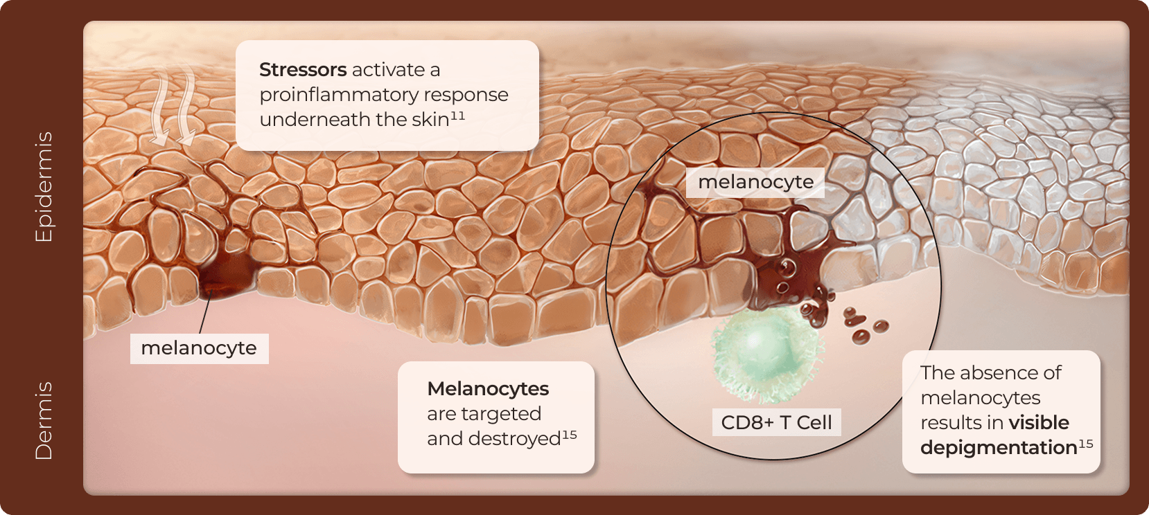 Vitiligo mechanism of disease based on currently known scientific literature.