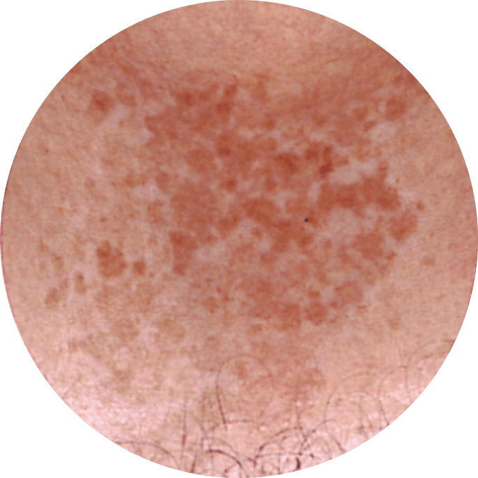 10 percent level of depigmentation.