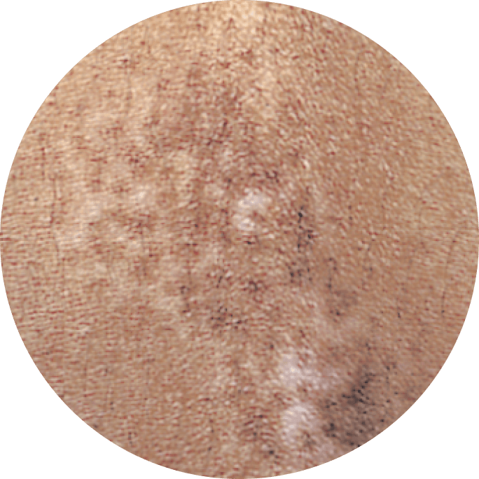 25 percent level of depigmentation.