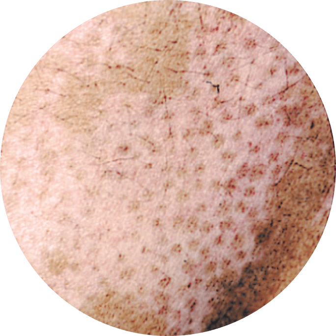 50 percent level of depigmentation.