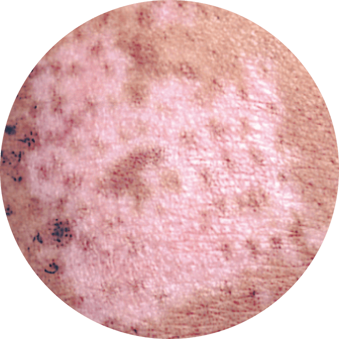 75 percent level of depigmentation.