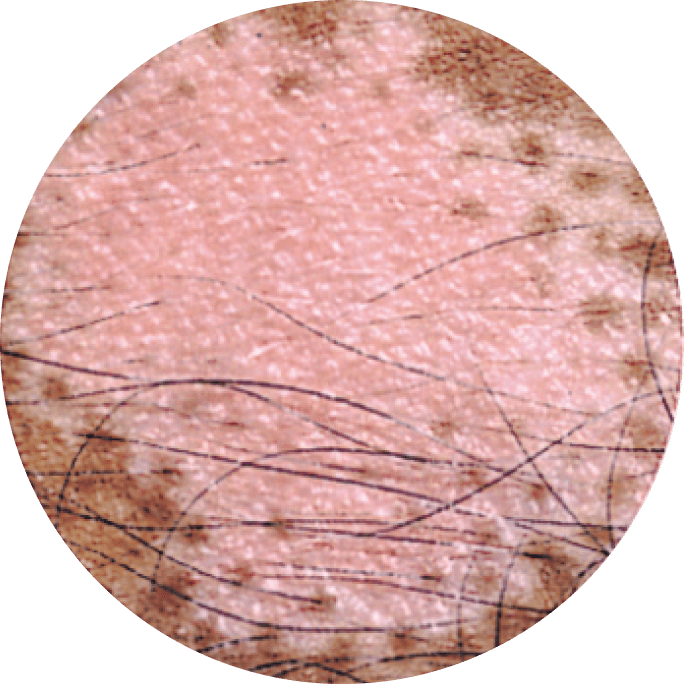 90 percent level of depigmentation.