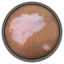 Marginal repigmentation.