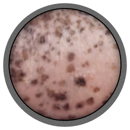 Perifollicular repigmentation.